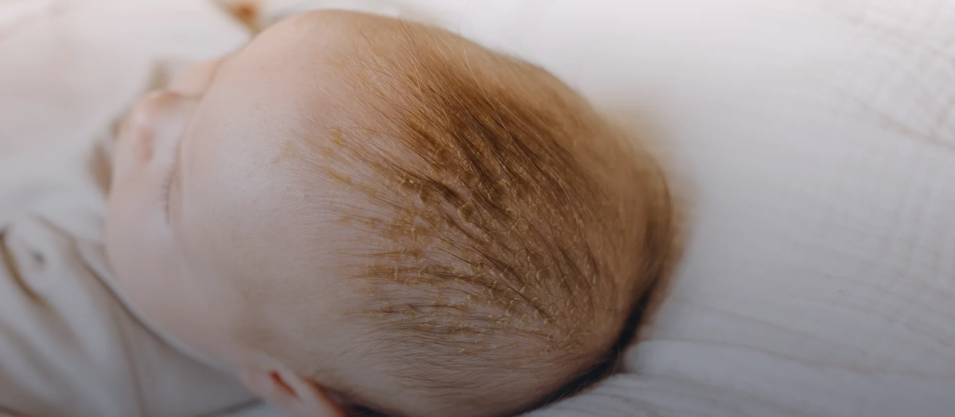 Neonato con crosta lattea sul cuoio capelluto